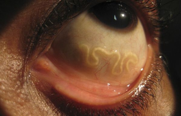 Viermele Loa Loa trăiește în ochiul uman și provoacă orbire